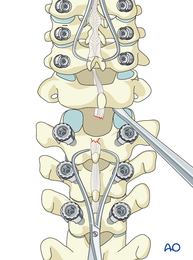 cervicothoracic junction posterior fixation