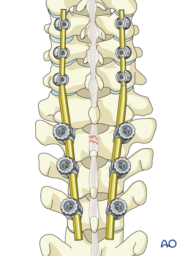 cervicothoracic junction posterior fixation