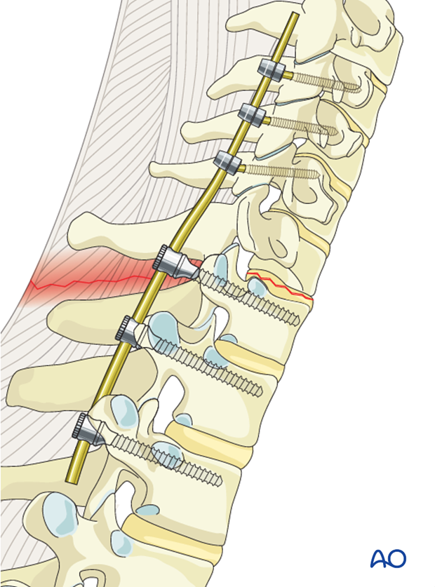 cervicothoracic junction posterior fixation