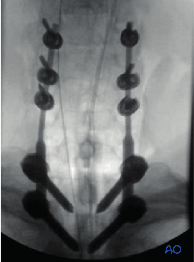 cervicothoracic junction posterior fixation