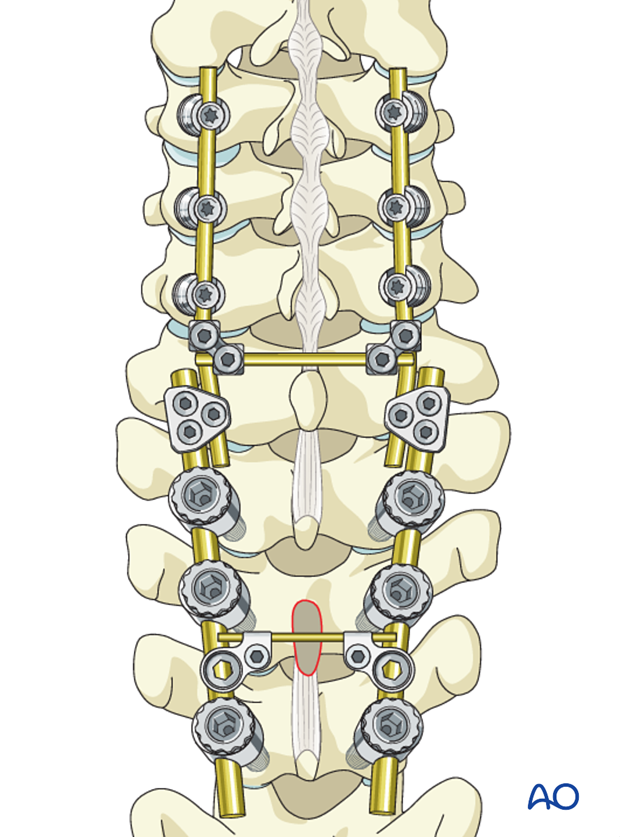 cervicothoracic junction posterior fixation