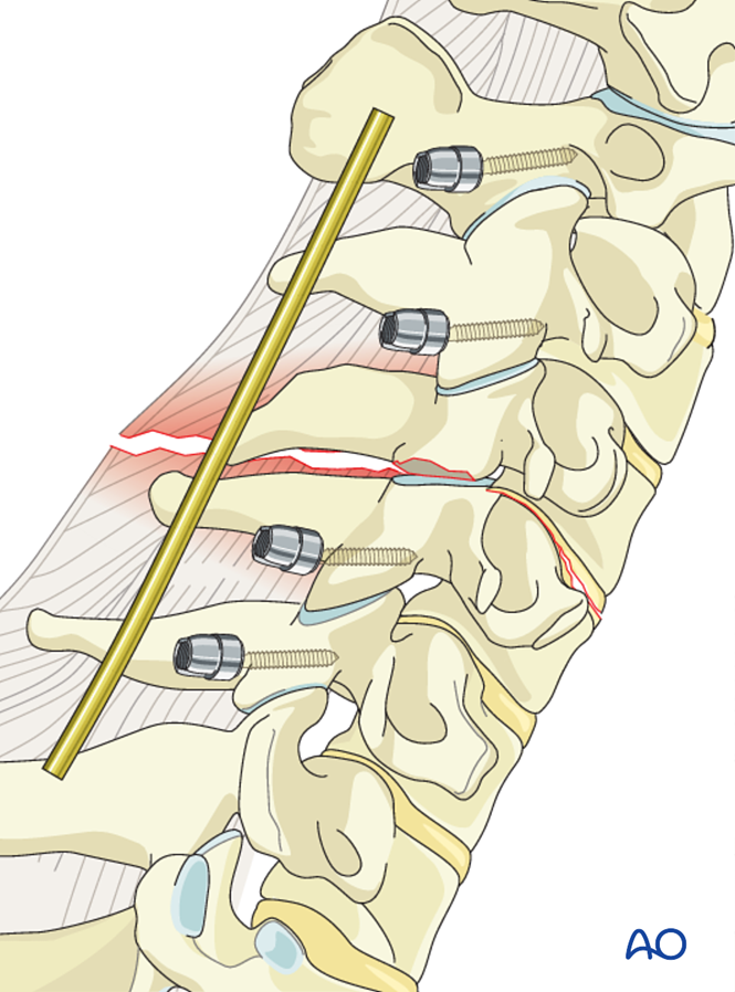 Cervical spine - posterior fixation for B2 Posterior tension band ...