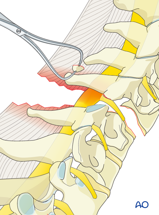 cervical spine posterior fixation