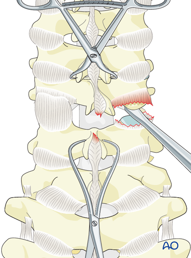 cervical spine posterior fixation