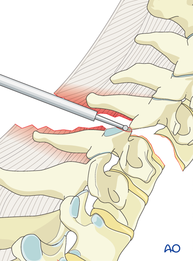 cervical spine posterior fixation