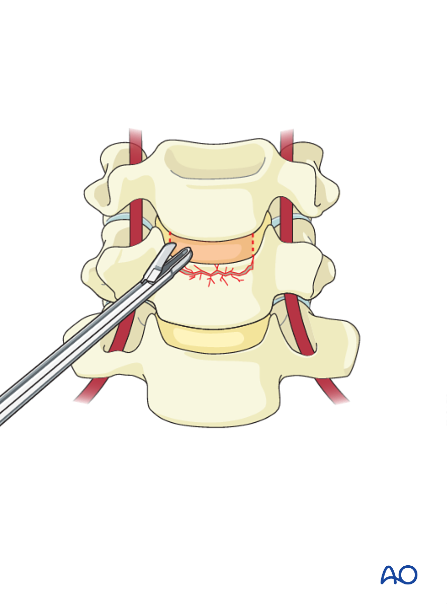 Anterior Plating For A1 Compression Fracture Single Endplate