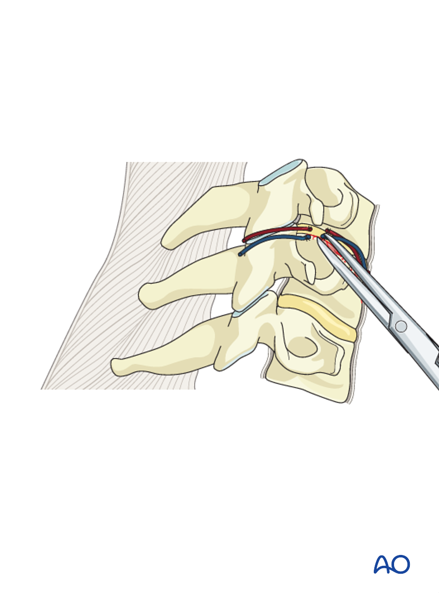 Anterior Plating For A1 Compression Fracture Single Endplate