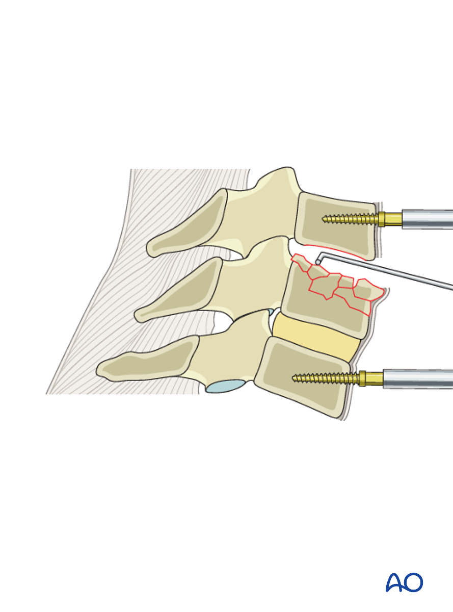 Anterior Plating For A3 Burst Fracture Of Single Endplate