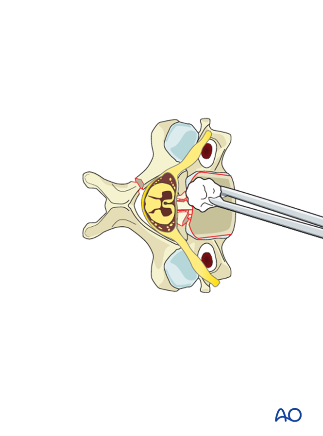 Anterior plating for A3 Burst fracture of single endplate