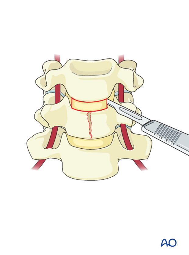 anterior plating