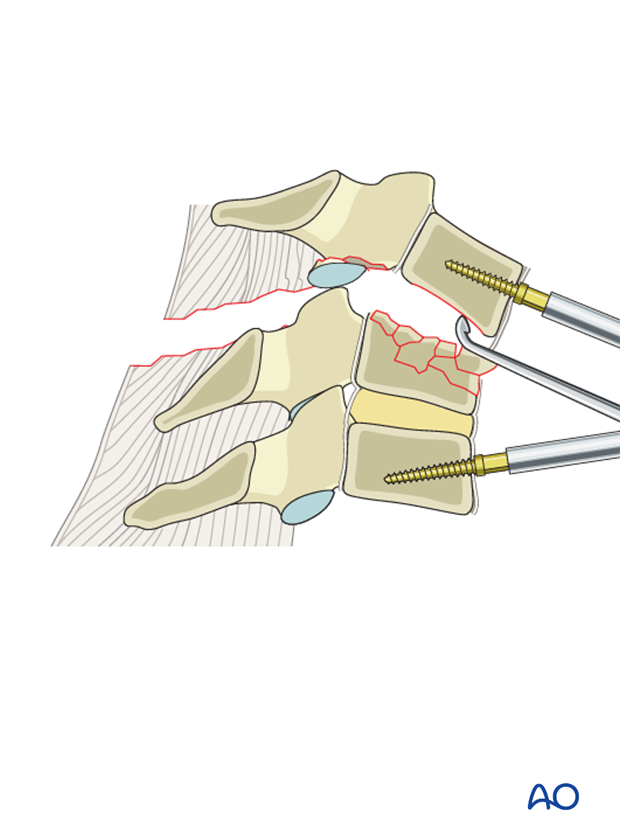 anterior plating