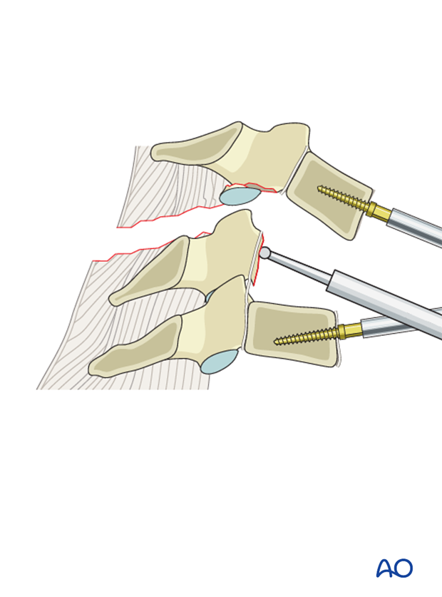 anterior plating