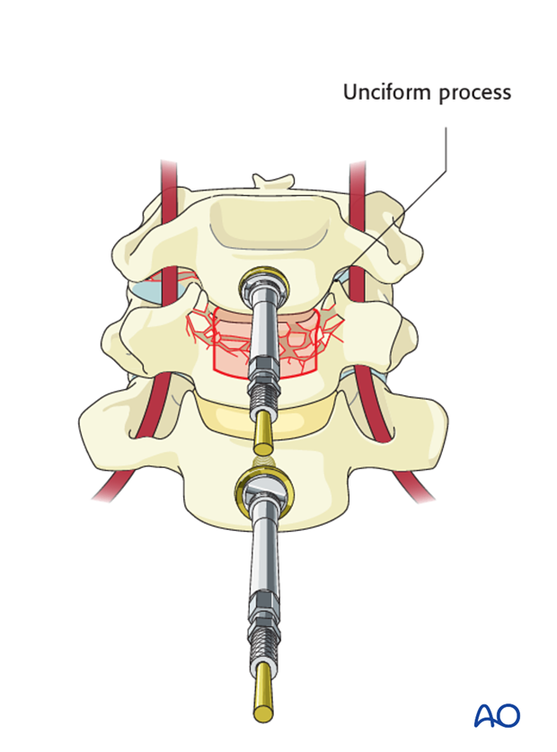 anterior plating