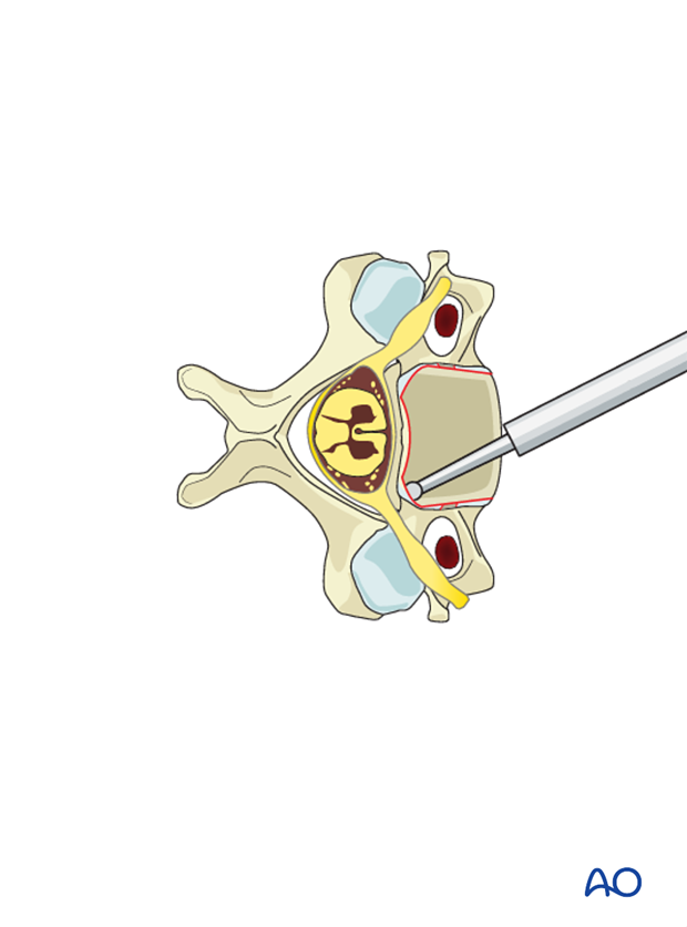anterior plating