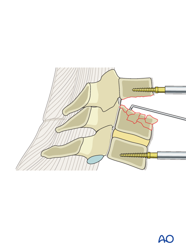 anterior plating