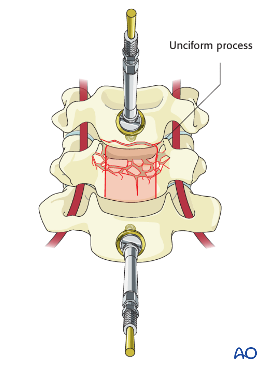 Anterior Plating For B3 Anterior Tension Band Injury