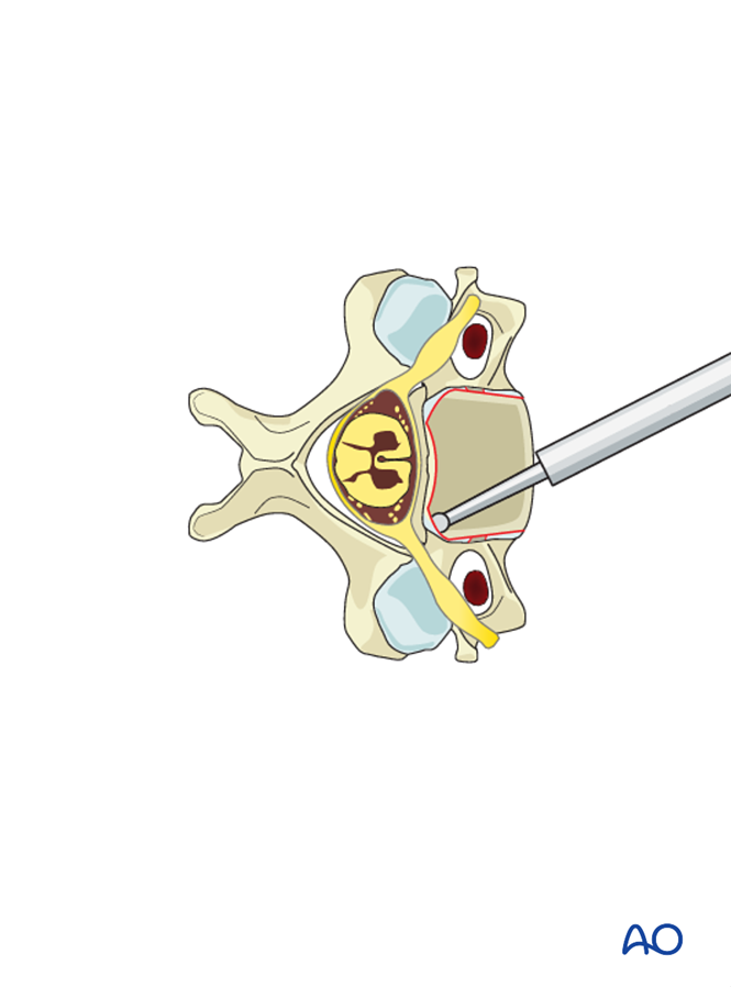 Anterior plating for B3 Anterior tension band injury