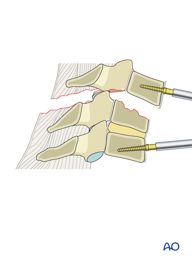 anterior plating