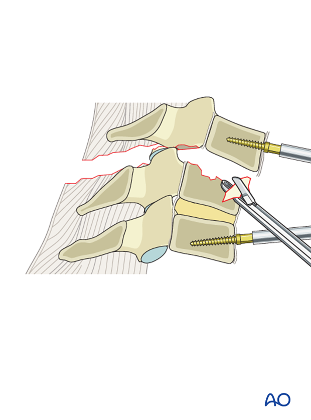 anterior plating