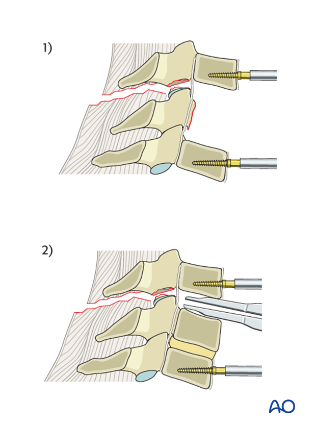 anterior plating