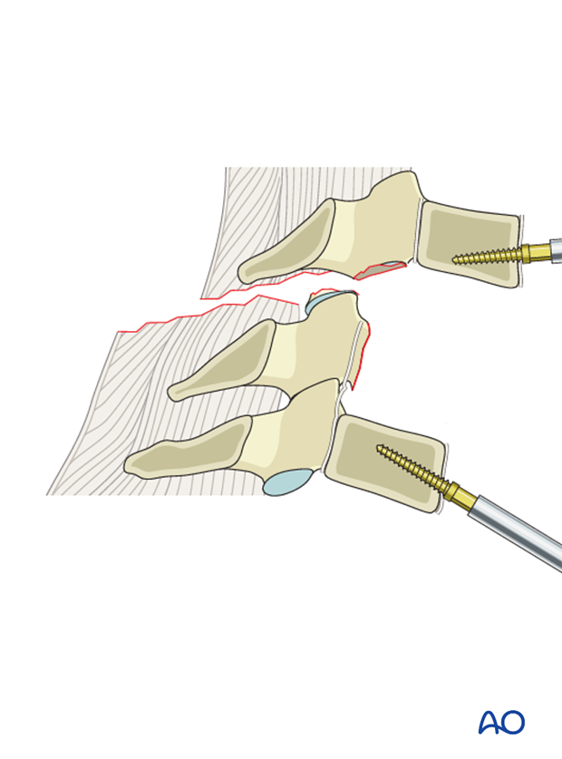 anterior plating