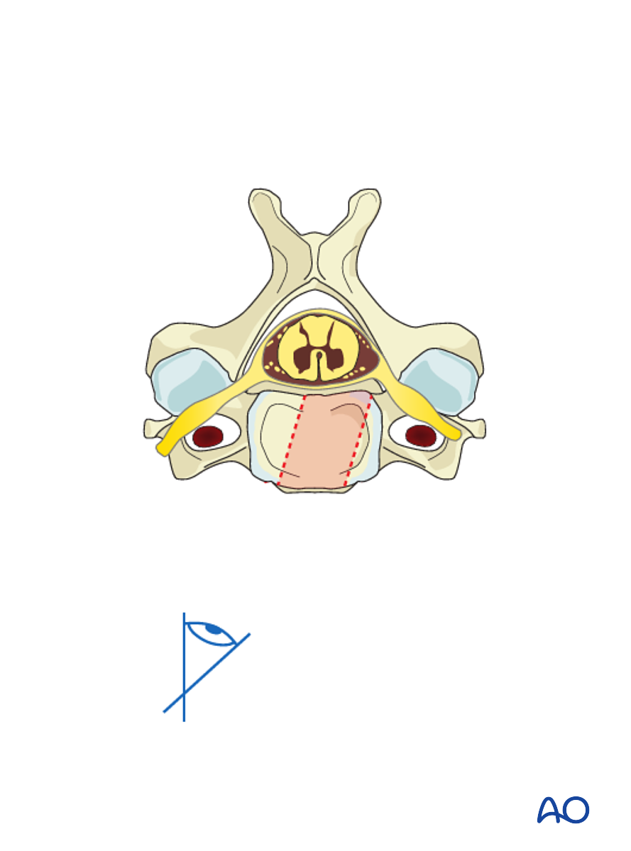 Anterior Plating For B3 Anterior Tension Band Injury