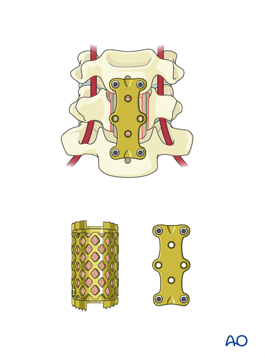 Anterior Plating For B3 Anterior Tension Band Injury