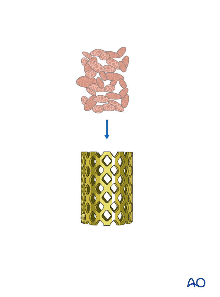 Anterior Plating For B3 Anterior Tension Band Injury