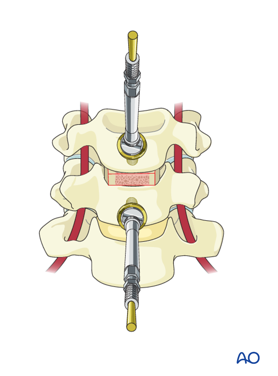 Anterior Plating For B3 Anterior Tension Band Injury