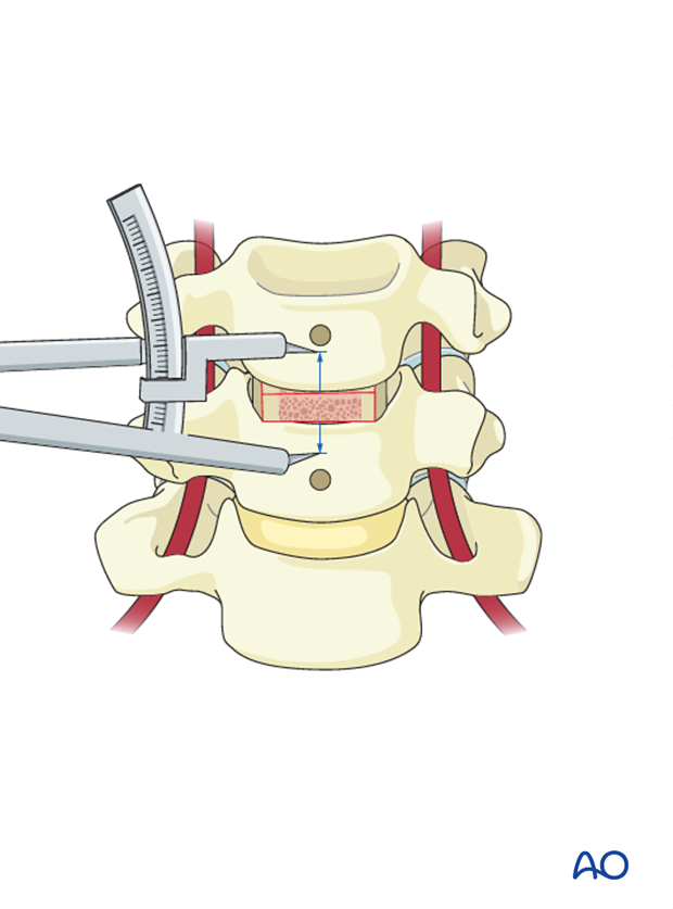 anterior plating