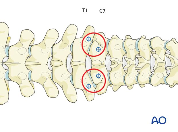 Step-off between the pedicles or lateral mass screws in the lower cervical spine and the upper thoracic spine