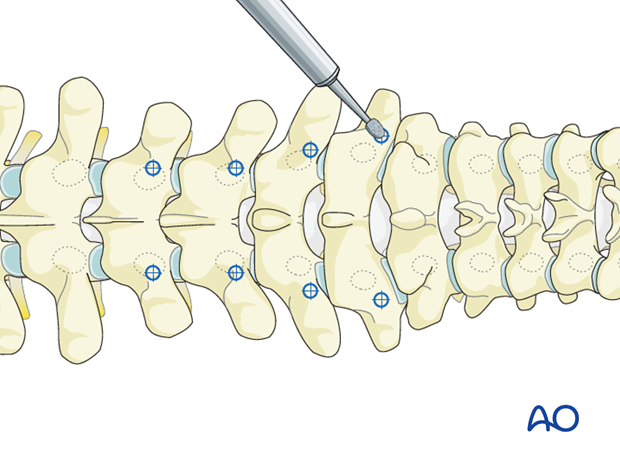 Opening the superficial cortex of the entry point with a burr or an awl during pedicle screw insertion (T1–T3).