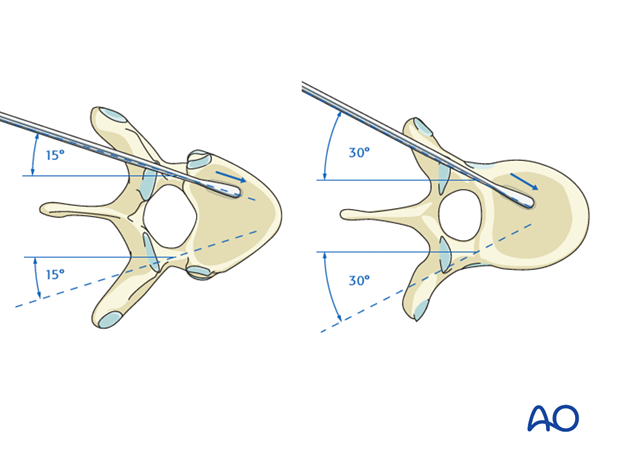Medio-lateral inclination during pedicle screw insertion (T1–T3)