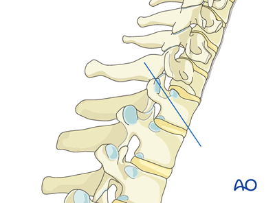 Pedicle Screw insertions T1 – T3