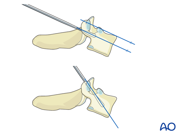 Pedicle preparation may be performed using the small 4 mm pedicle probe during pedicle screw insertion (T1–T3).