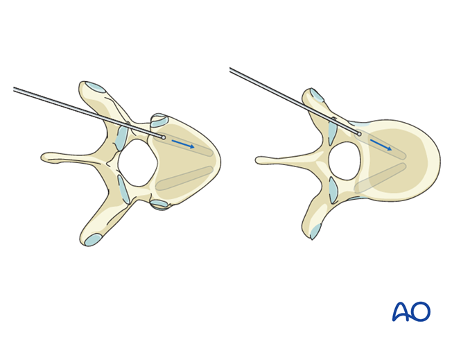 Pedicle Screw insertions T1 – T3