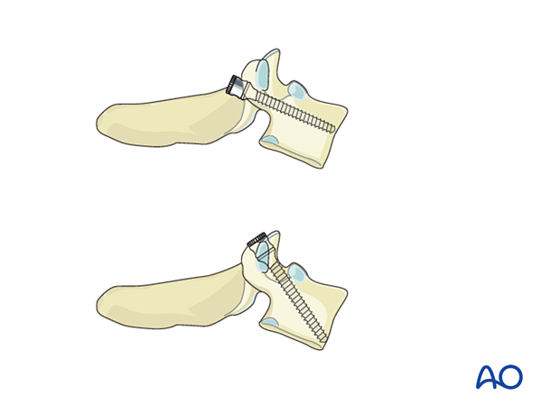 Either polyaxial screws, like in the cervical spine, or monoaxial thoracic type screws can be used during pedicle screw insertion (T1–T3).