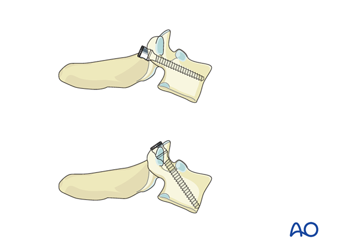 En bloc resection of an anterior tumor (C1 to C7) for Benign cervical ...