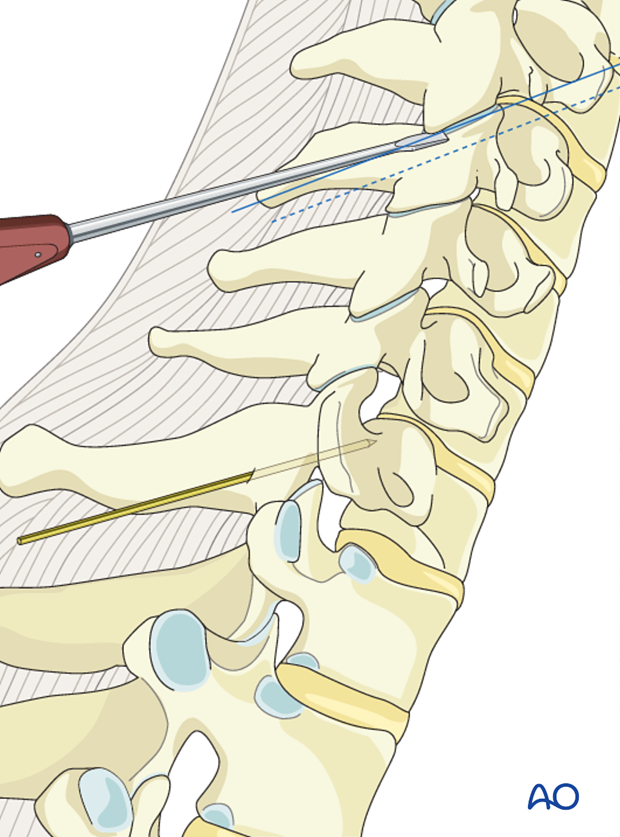 Cranial-caudal angulation during lateral mass screw insertion magerl technique