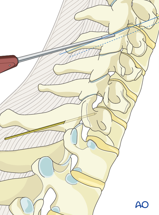 Lateral mass screw insertion (Magerl technique)