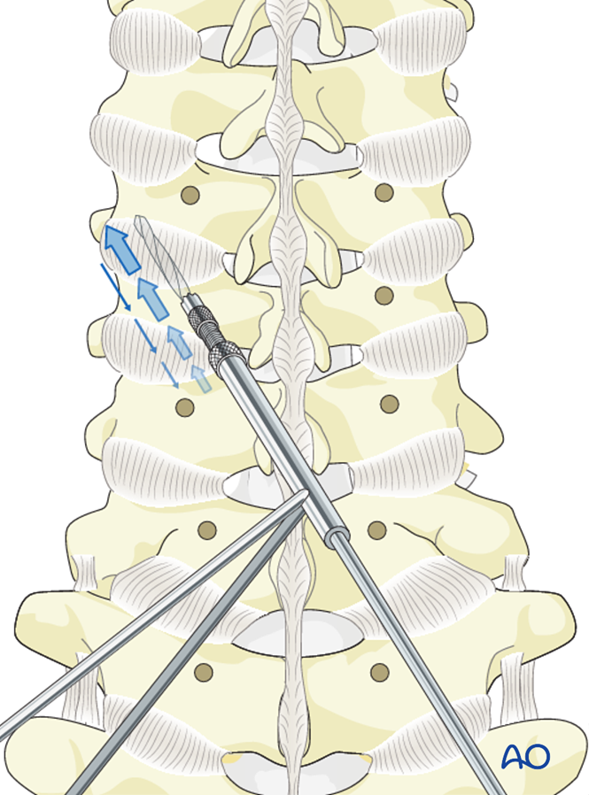 Lateral Mass Screw Insertion Magerl Technique