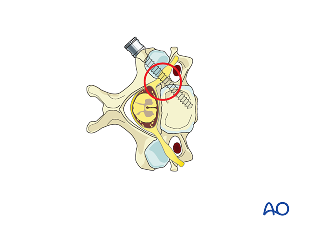 Between C3 and C6 the vertebral artery and cervical nerve root are close to the pedicle. Screw malposition must be avoided during pedicle screw insertion.