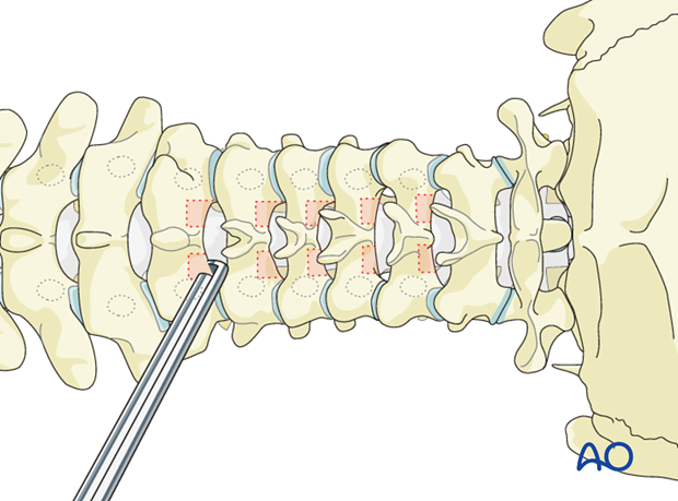 Laminectomy performed during cervical pedicle screw insertion