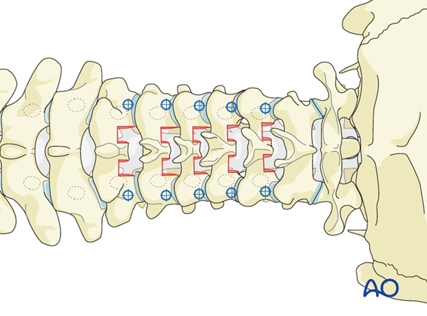 Entry points for cervical pedicle screw insertion
