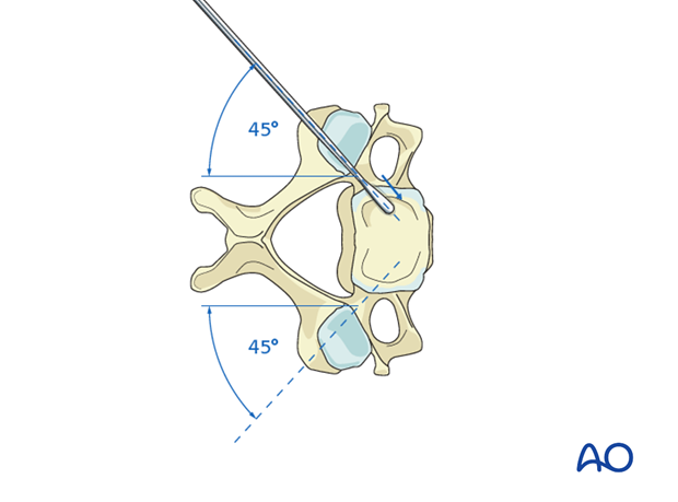 Medio-lateral inclination during cervical pedicle screw insertion.