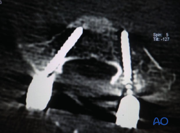 Screw diameter is determined based on preoperative CT measurements of the height and width of the pedicles during cervical pedicle screw insertion.