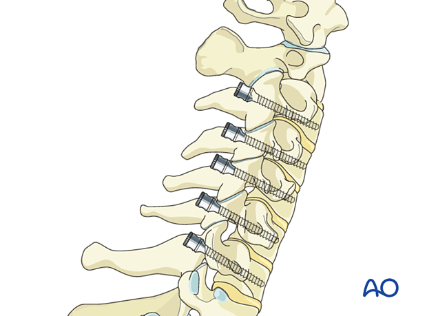 The screw is inserted through the created trajectory during cervical pedicle screw insertion.
