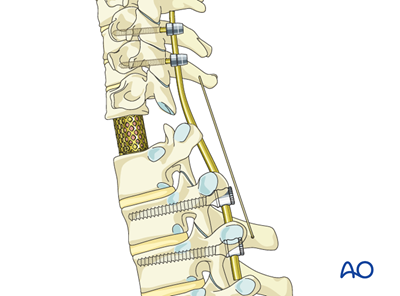Postoperative cervical deformities