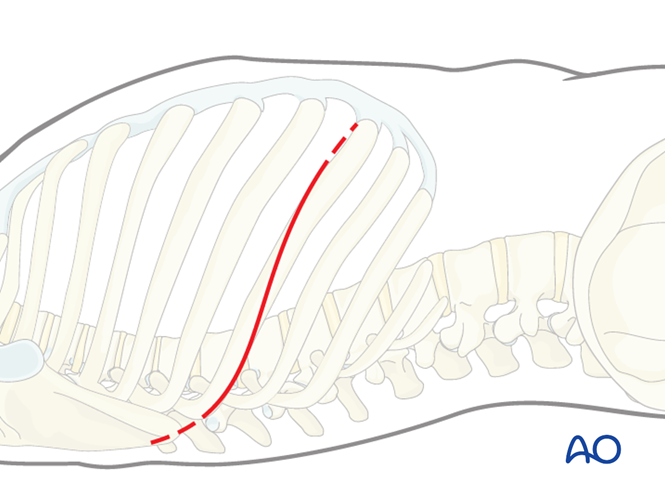 T Incision Classical Right sided thoracotomy (T3-T10)