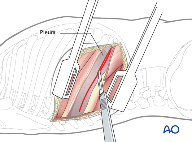 Thoracic and lumbar fractures: Right sided thoracotomy (T3-T10)